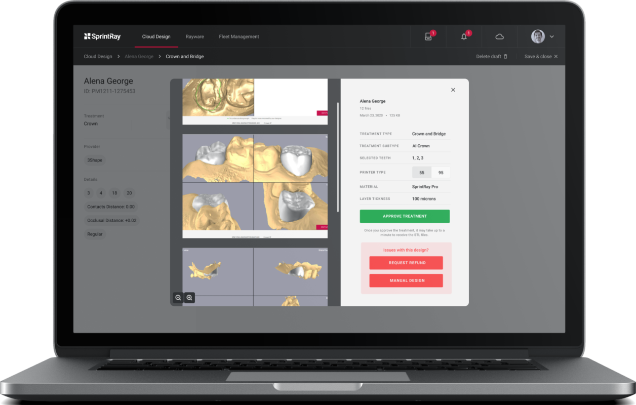 Images de synthèse de couronnes sur le logiciel de la marque SprintRay
